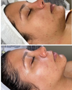 Clear improvement in skin tone and texture after a series of facial treatments