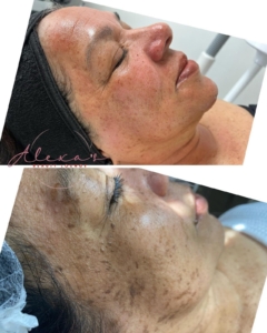 Freshly treated face after a Hydrafacial service