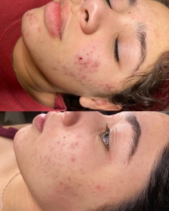 Hydrafacial treatment