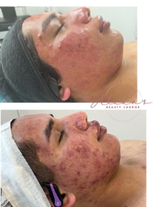 clear skin transformation